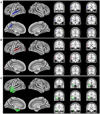 Clinical Correlates of Alzheimer's Disease Cerebrospinal Fluid Analytes in Primary Progressive Aphasia